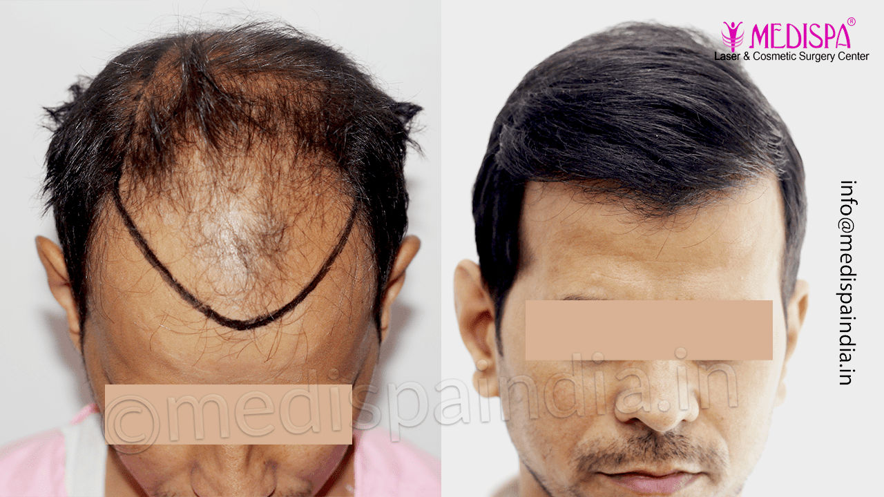 best hair transplant surgeon delhi