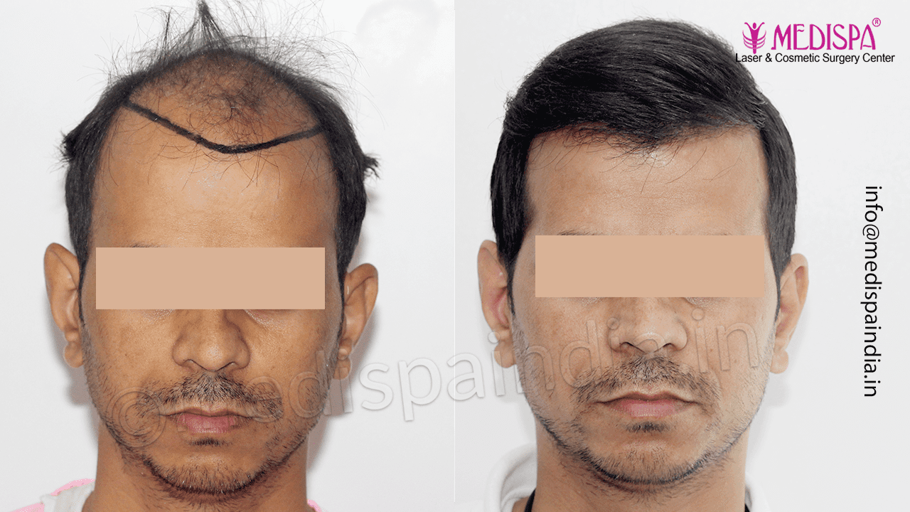 hair transplant delhi cost