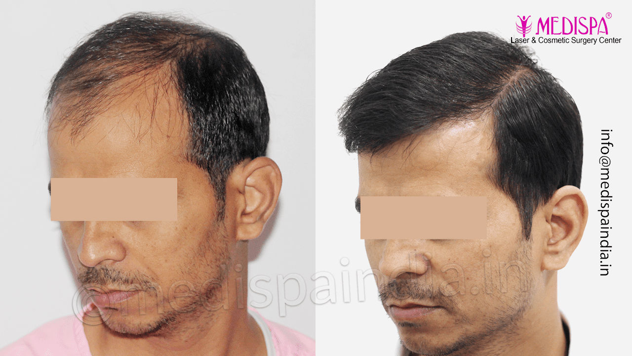 best hair transplant surgeon mumbai
