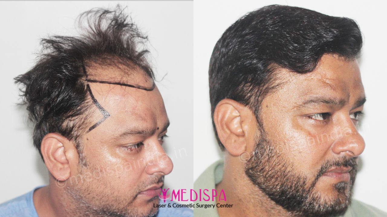 hair transplant clinic in delhi
