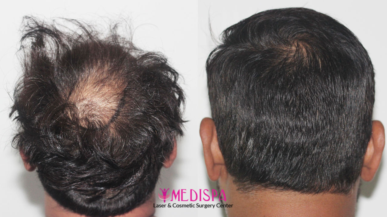 hair transplant clinic india