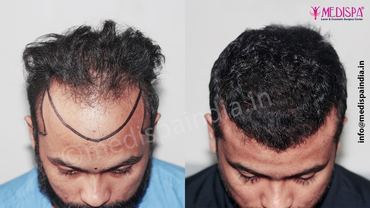 hair transplant cost delhi