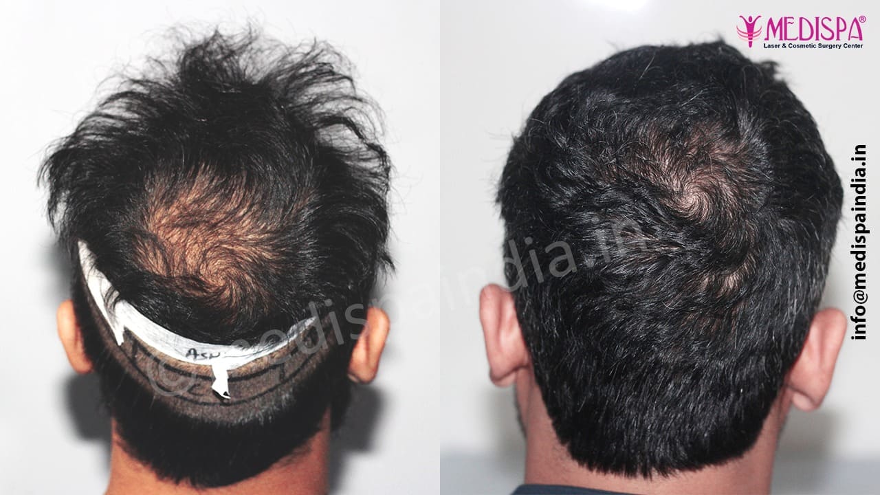 hair transplant cost dubai