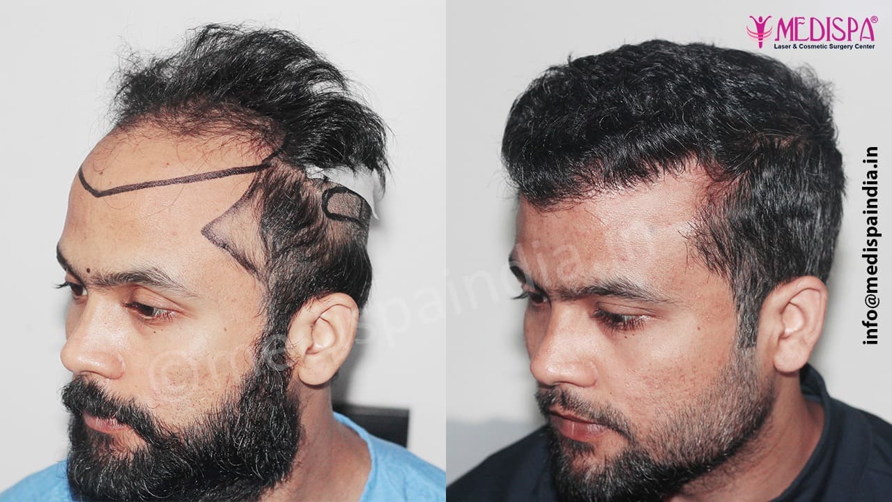 hair transplant cost india