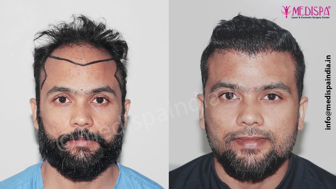 hair transplant cost in india