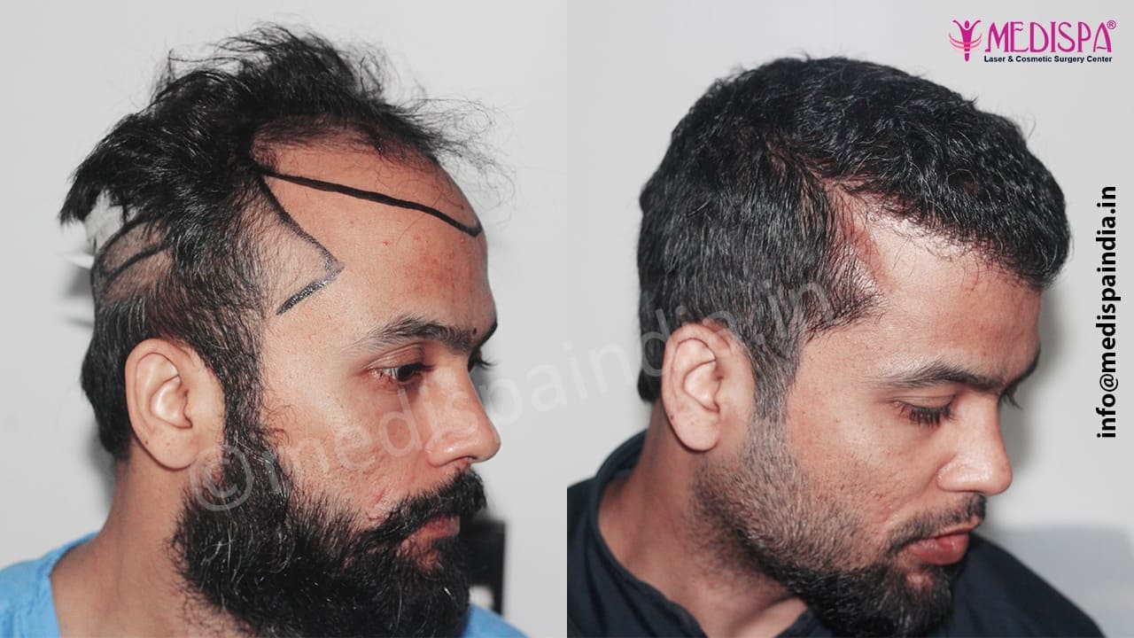 hair transplant cost rajasthan