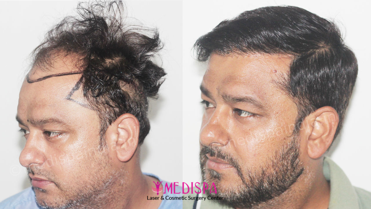 top hair transplant clinic in india