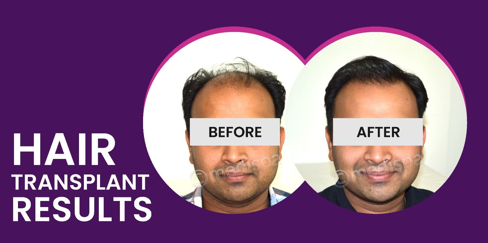 How To Achieve Successful Results With Hair Restoration?