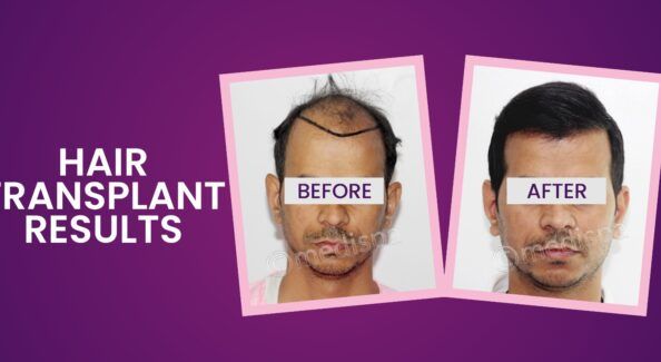 Regrow Your Confidence With Advanced Hair Transplant Solutions