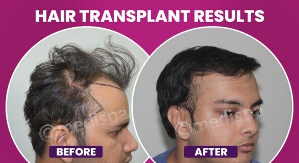 How Primary Consultation Is Helpful In Hair Transplantation?
