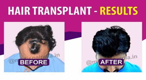 How To Prepare For Hair Restoration?