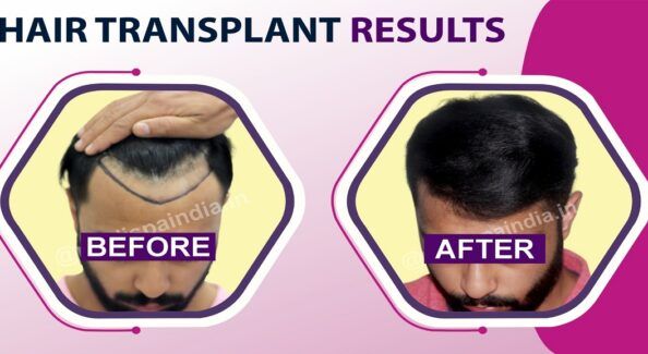 Hair Transplantation: The Ultimate Solution For High Baldness