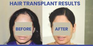 How To Find The Best Clinic For Female Hair Transplant?