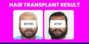 Elaborate The Factors While Choosing A Hair Transplant Doctor