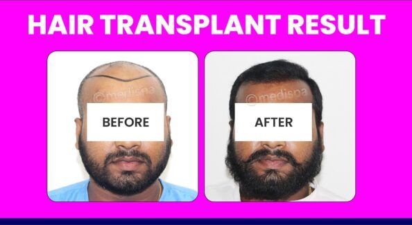 Elaborate The Factors While Choosing A Hair Transplant Doctor