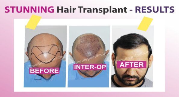 The Process of Hair Transplantation: What To Expect?