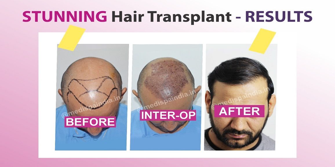 The Process of Hair Transplantation: What To Expect?