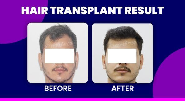 How To Research About The Clinic Before Hair Transplantation?