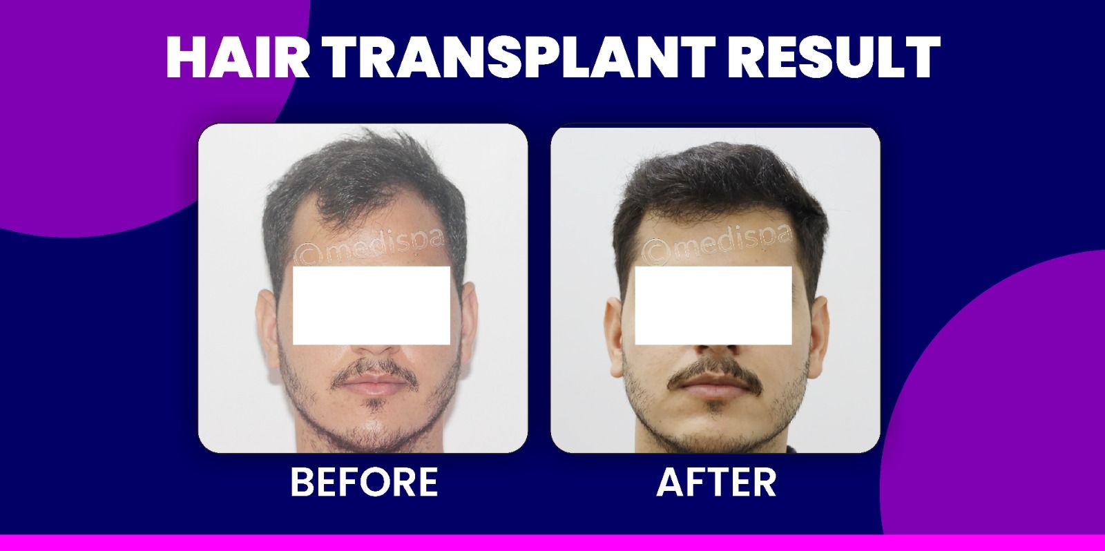 How To Research About The Clinic Before Hair Transplantation?