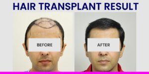 Is Hair Transplant A Painless Surgical Procedure?