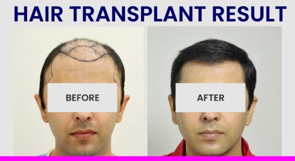Is Hair Transplant A Painless Surgical Procedure?