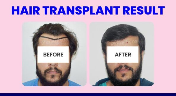 Hair Transplant: Important Factors To Know Before Undergoing