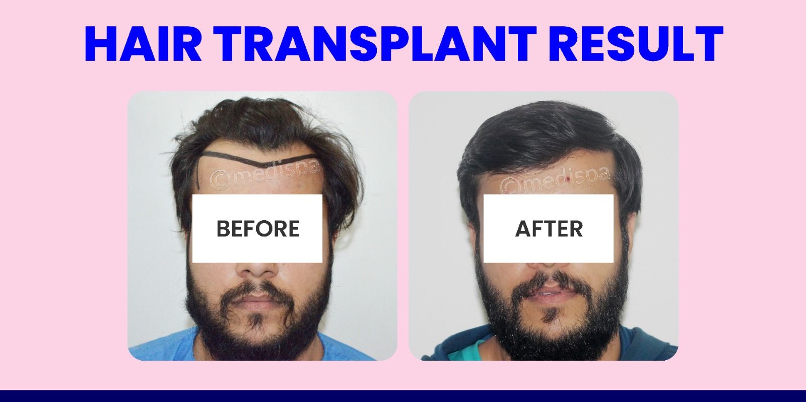 Hair Transplant: Important Factors To Know Before Undergoing