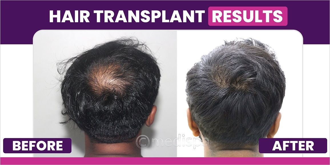 Hair Transplant Surgery: The Secret To A Fuller Head of Hair