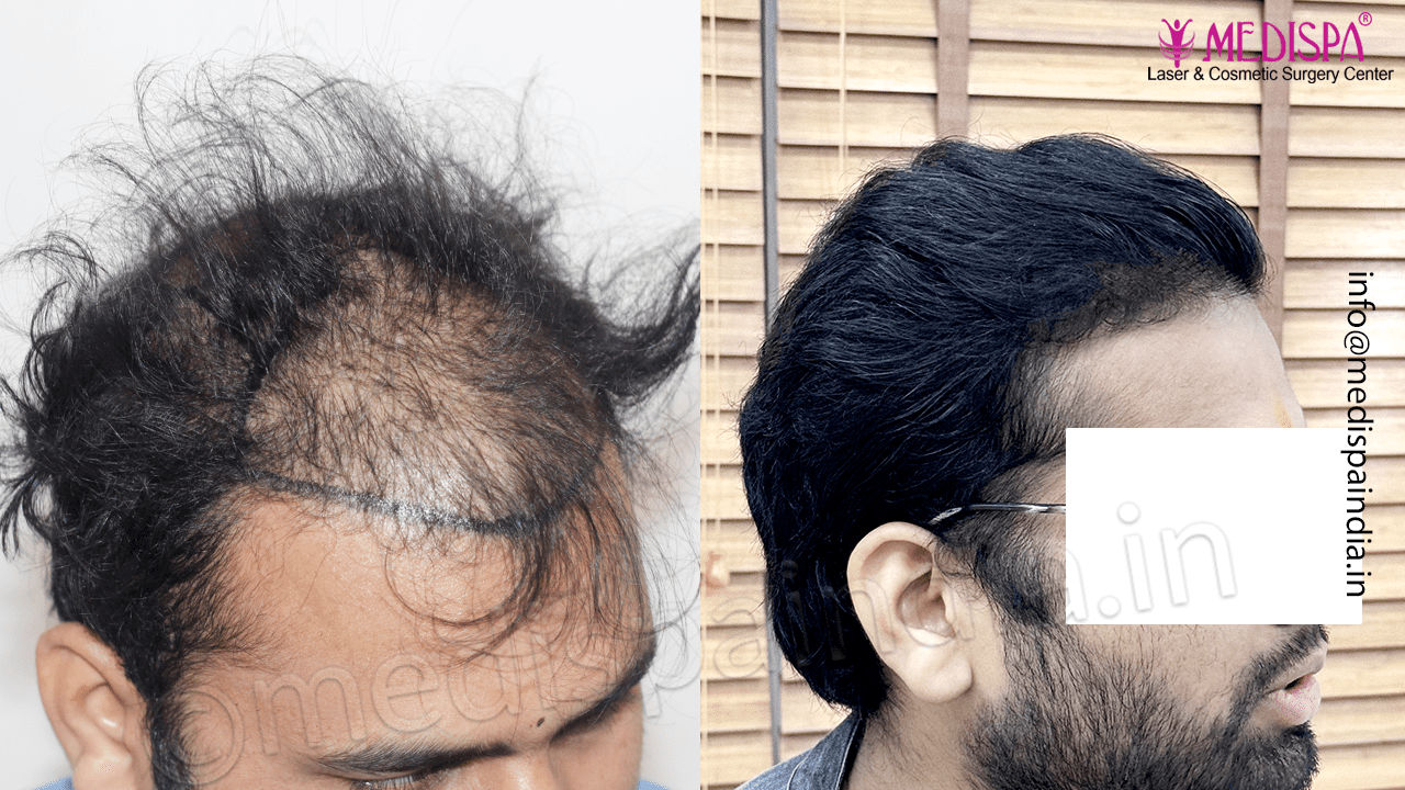 bangalore hair transplant