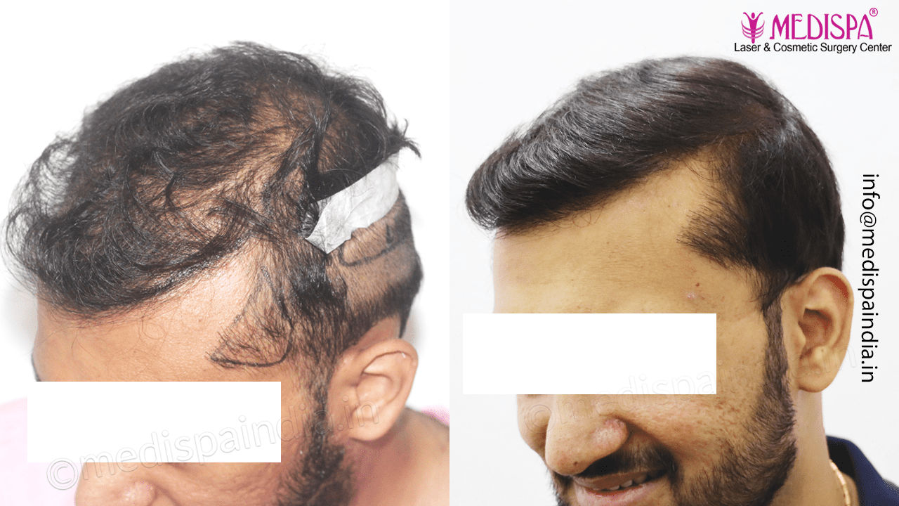 best hair restoration delhi