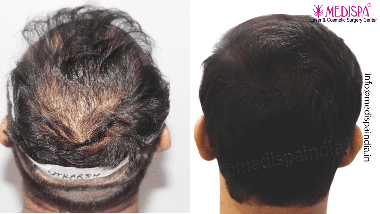 best hair restoration delhi