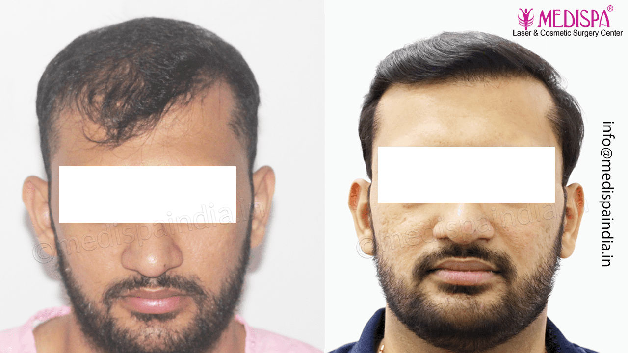 hair transplant result in india