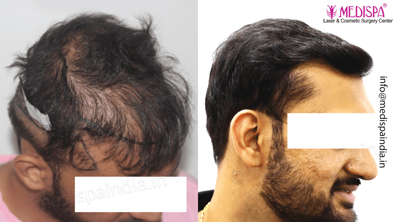 best hair restoration delhi
