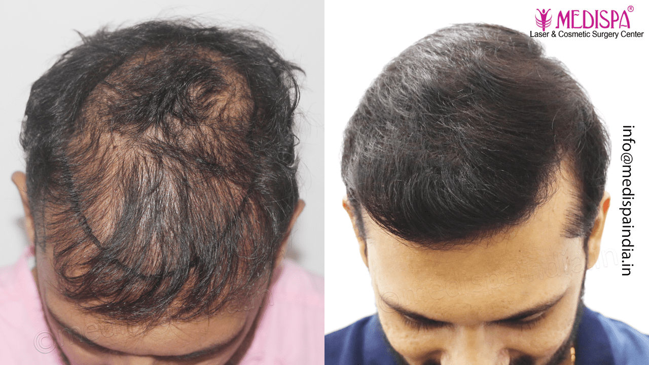 best hair restoration delhi