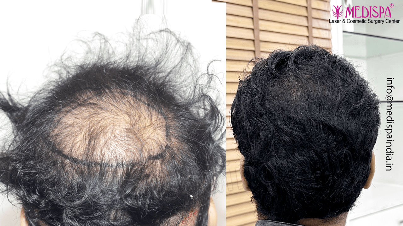 bangalore hair transplant