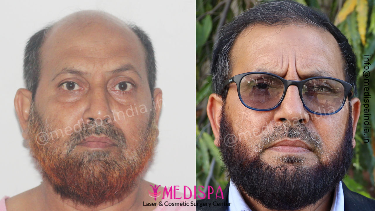 Hair Restoration in India