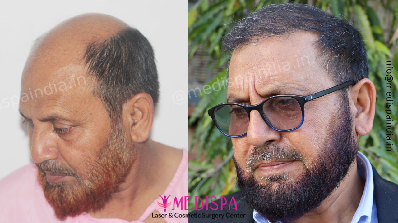 hair transplant cost india