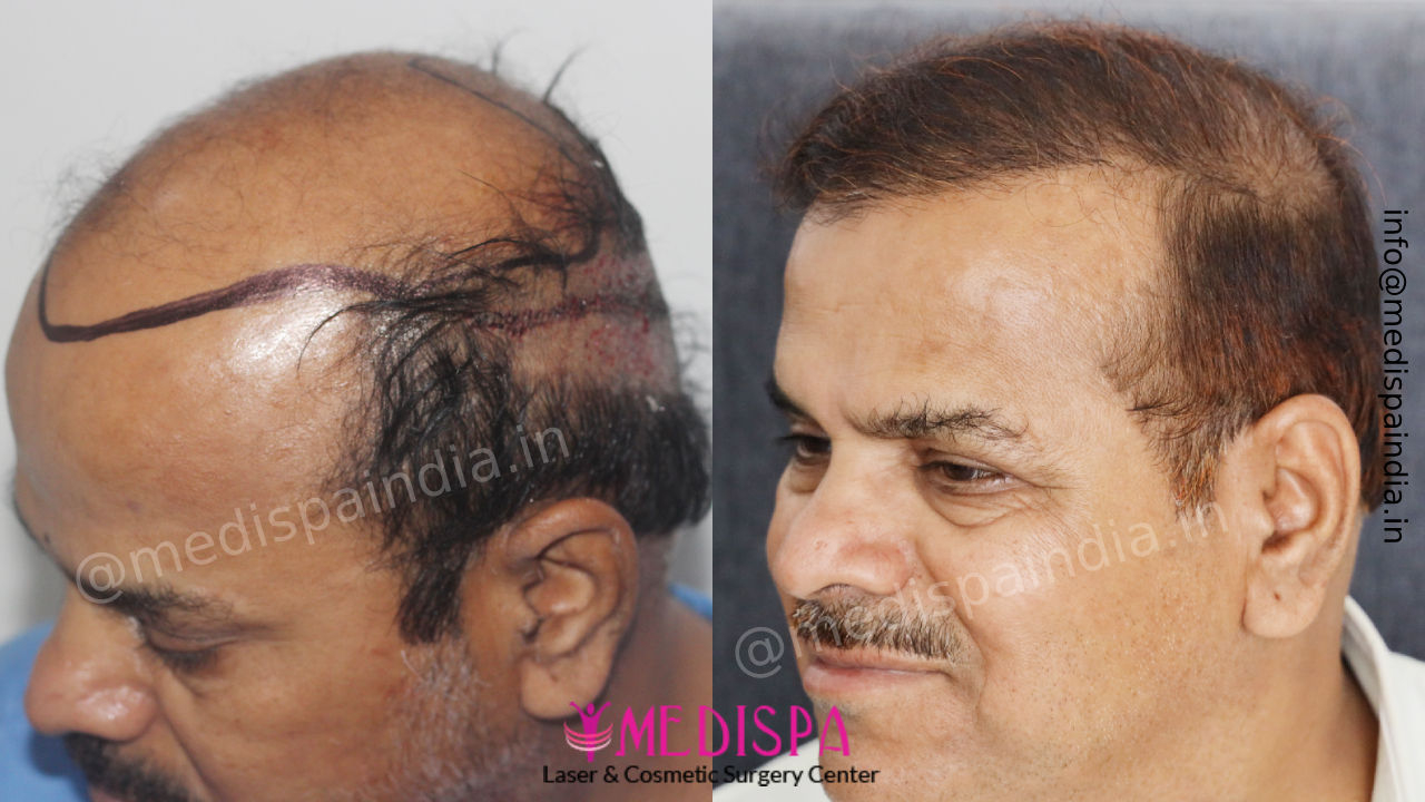 hair transplant delhi
