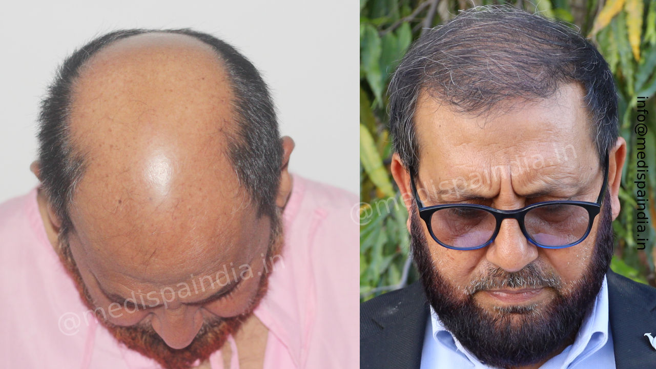 hair transplant hyderabad