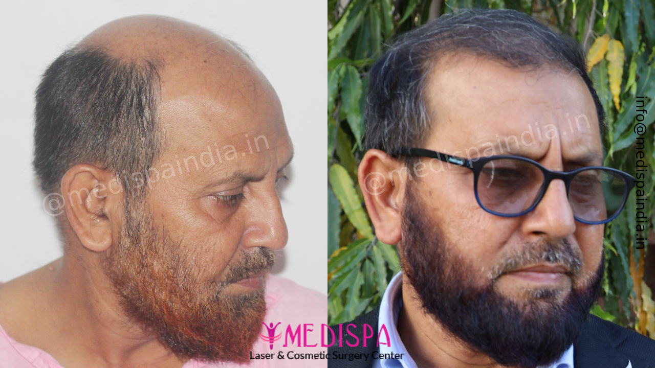 hair transplant india