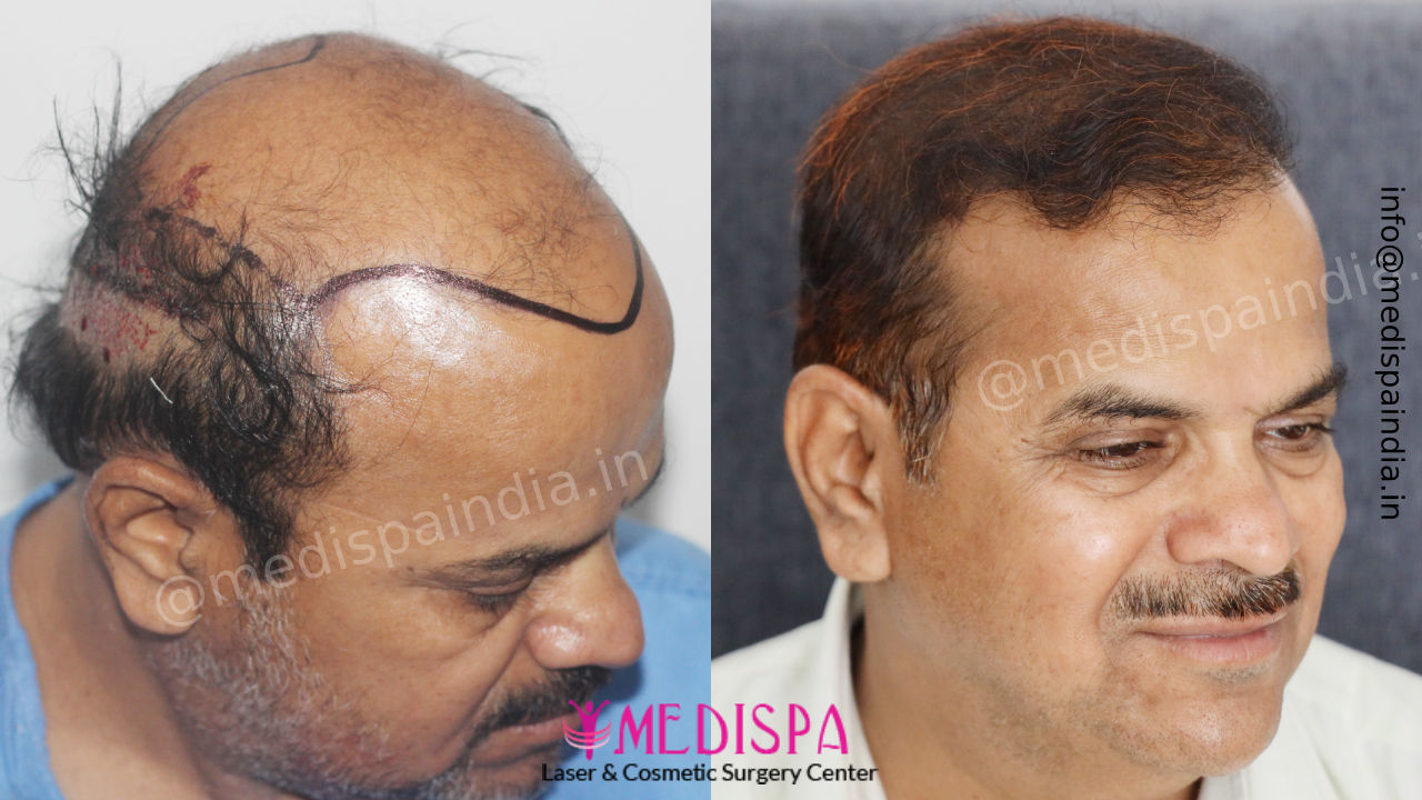 hair transplant jaipur