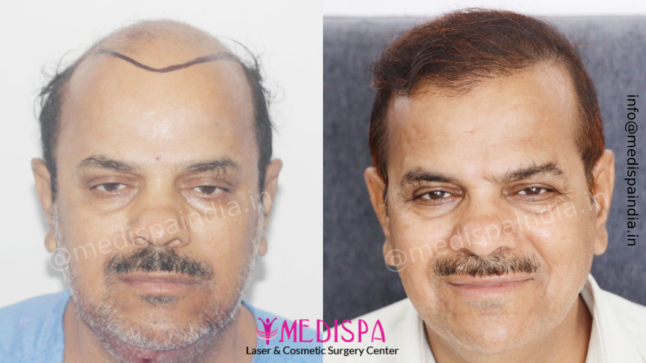 hair transplant cost in india