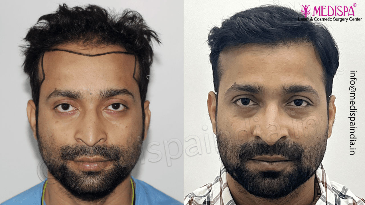 hair transplant hyderabad cost