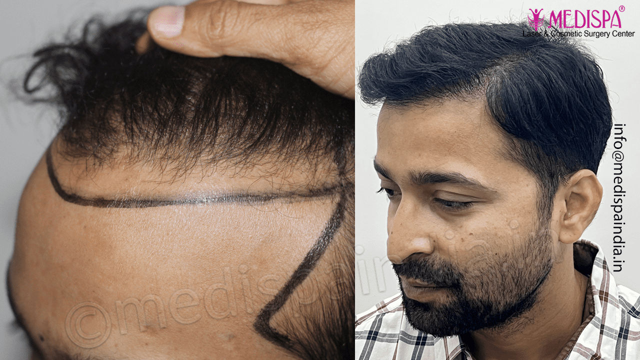 jaipur hair transplant results