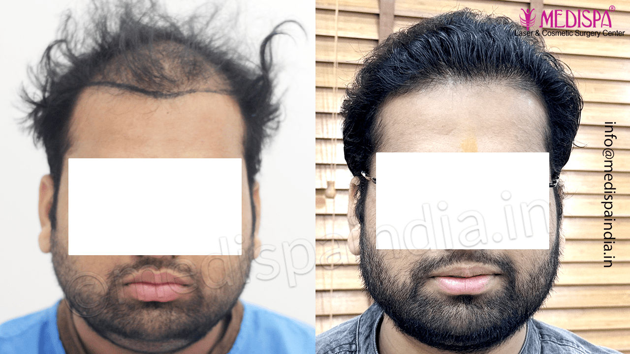 hair restoration cost india
