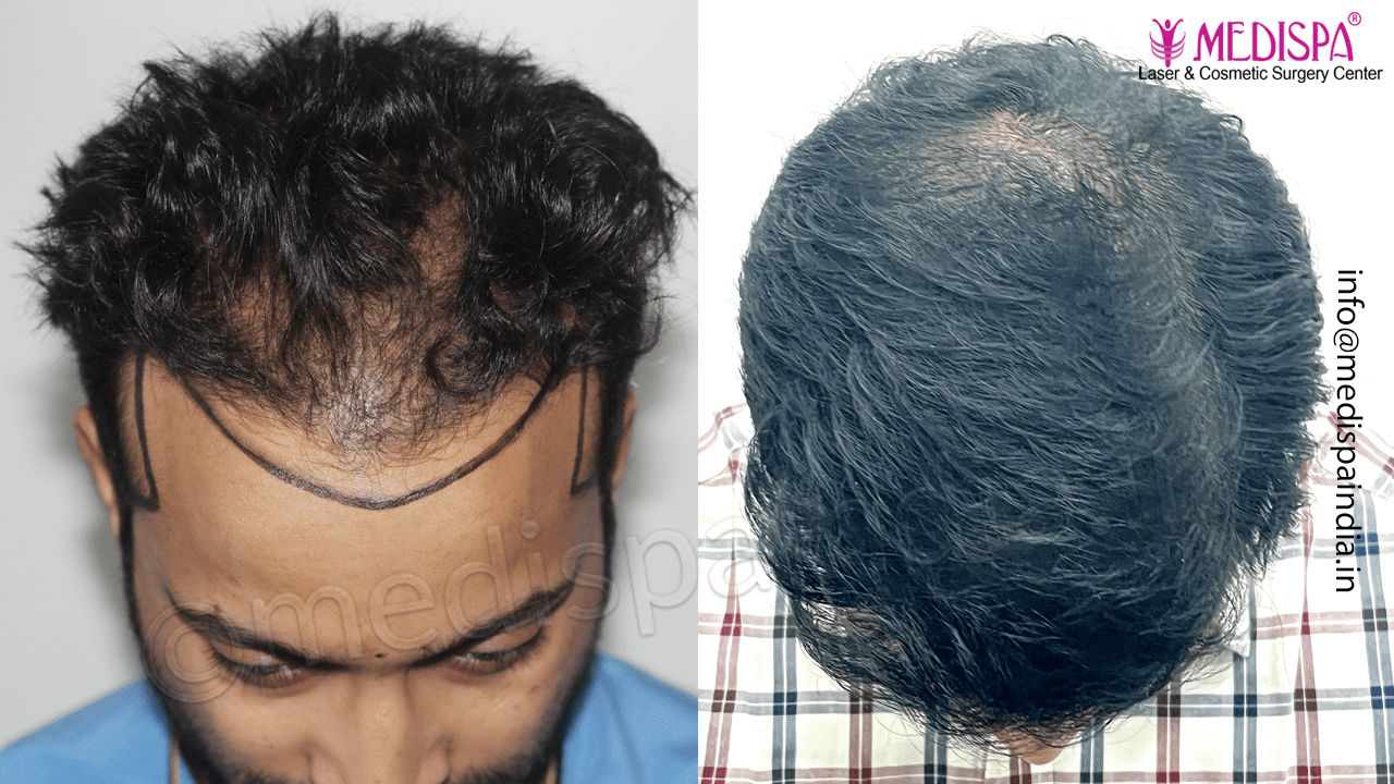 jaipur hair transplants