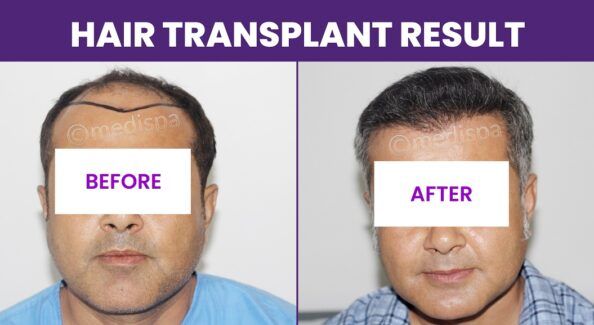 Significant Aspects of Hair Transplantation