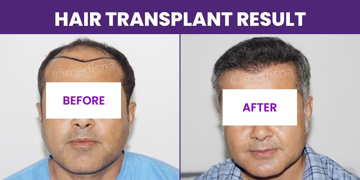 Significant Aspects of Hair Transplantation