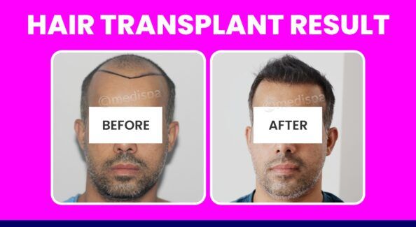 How To Enhance The Hair Growth Rate After Hair Transplant Surgery?