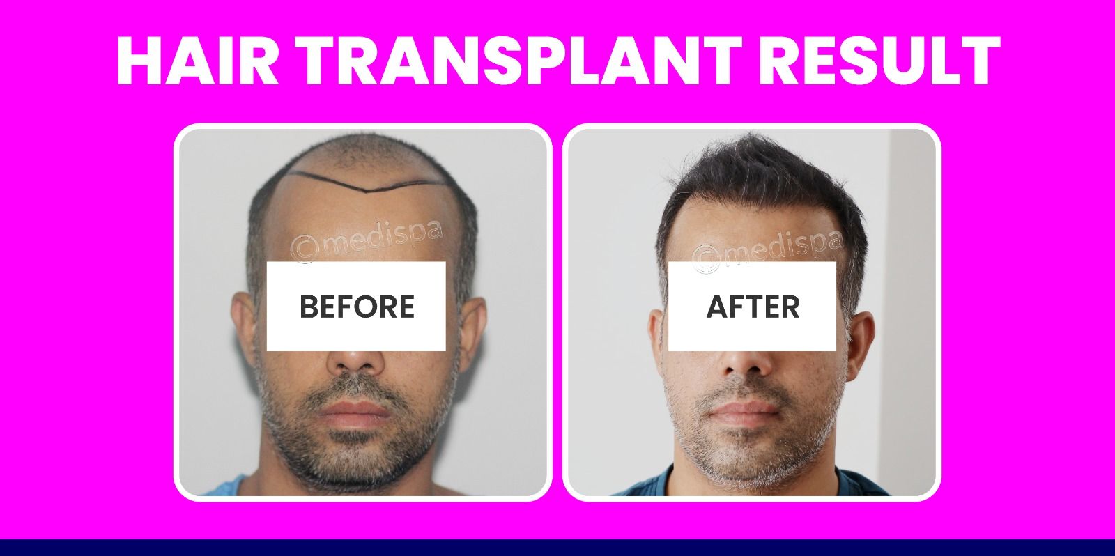 How To Enhance The Hair Growth Rate After Hair Transplant Surgery?